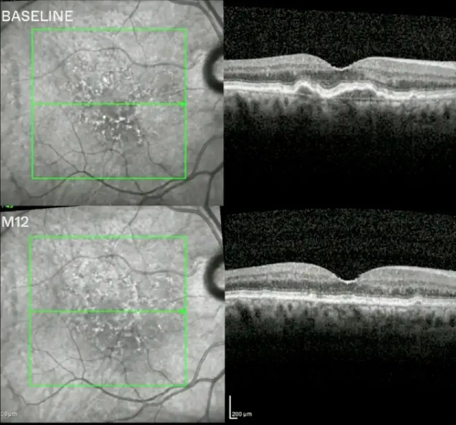 Optical coherence tomography (OCT) retinal scans comparing baseline and 12-month follow-up images, showing changes in the macula over time.